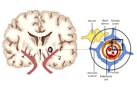Dépression et neurodégénérescence