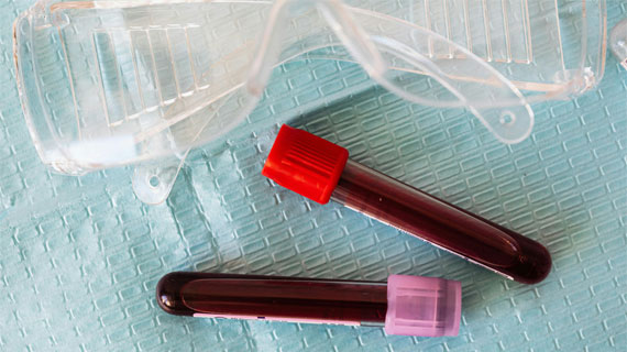 Trouble bipolaire : Étude d'acceptabilité d’un test sanguin innovant à visée diagnostique