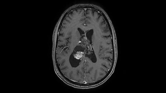 Quand le cerveau parle par la psyché : un neurocytome intraventriculaire à révélation psychiatrique