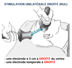 Simulation unilatérale droite (RUL)